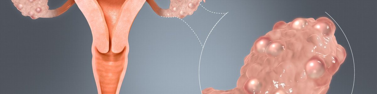 Polycystic_Ovaries